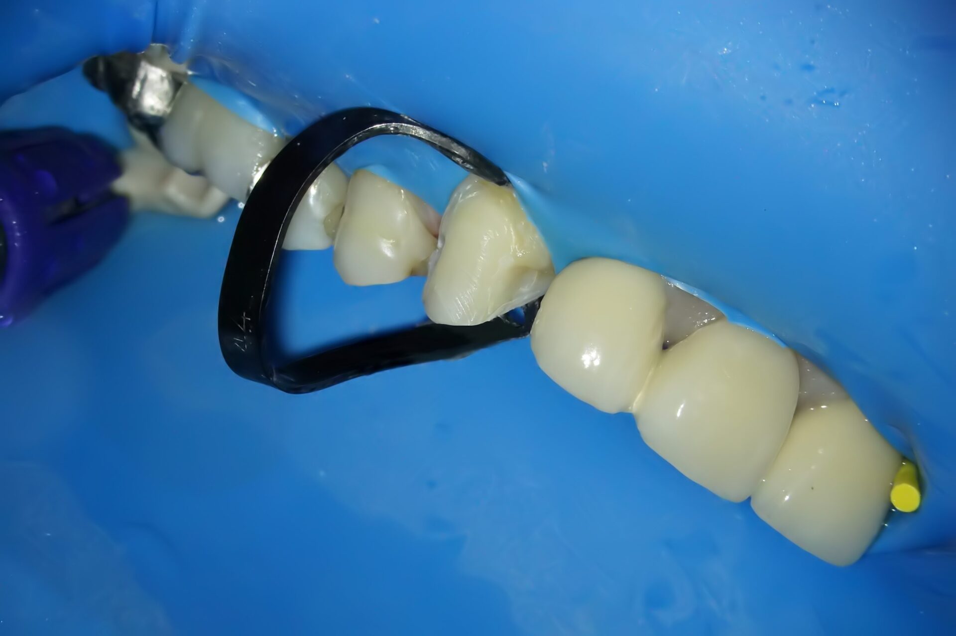 虫歯治療2治療方法05