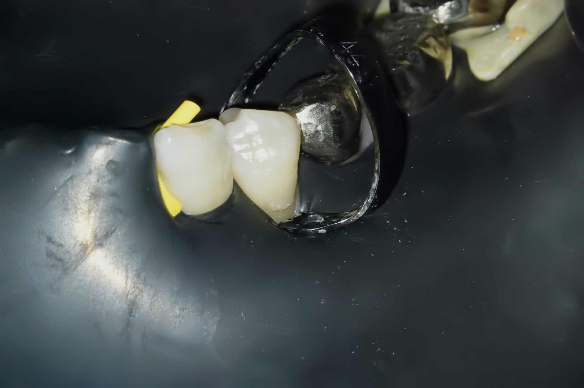 虫歯治療1治療方法01