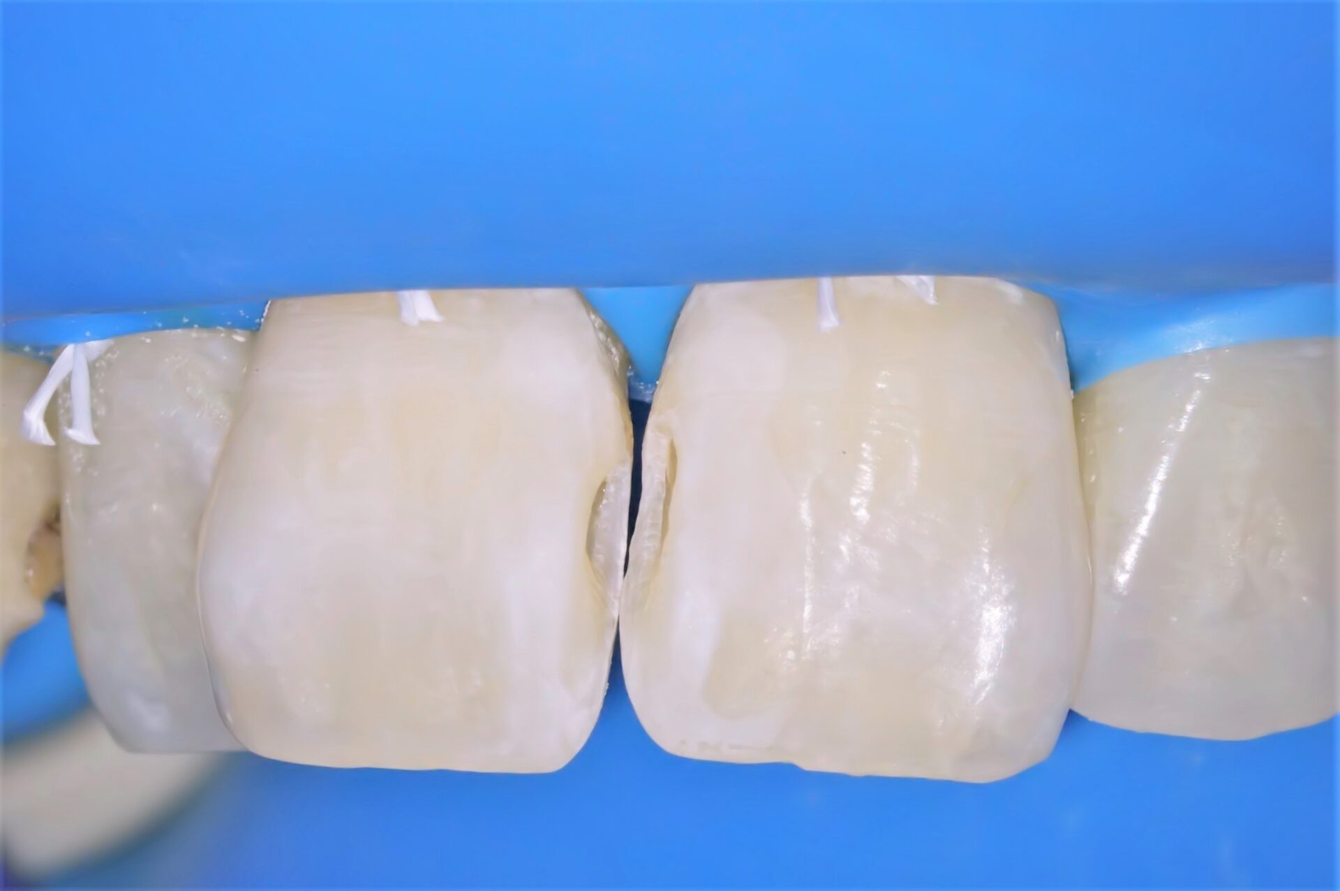 虫歯治療3治療方法02