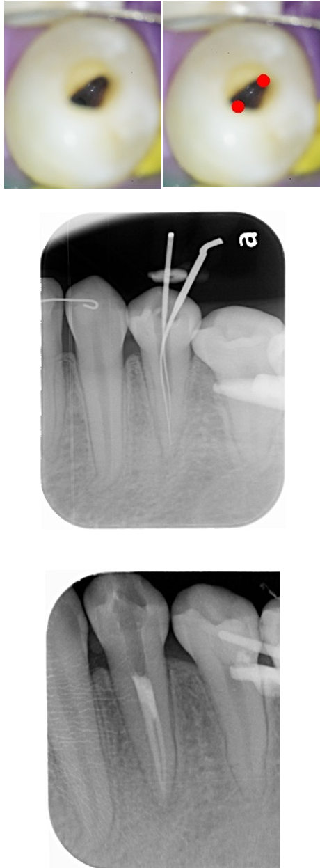 痛みが強い歯に行った精密根管治療治療方法06