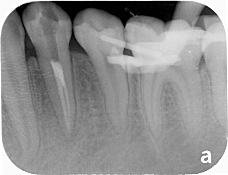 痛みが強い歯に行った精密根管治療BEFORE