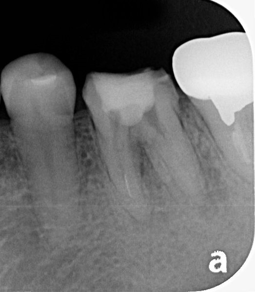 違和感が残る歯への再根管治療治療方法02