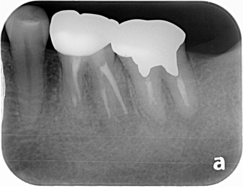 違和感が残る歯への再根管治療治療方法04
