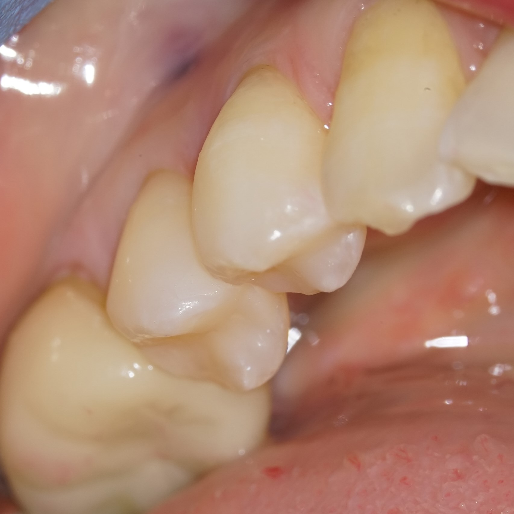 虫歯治療5治療方法06