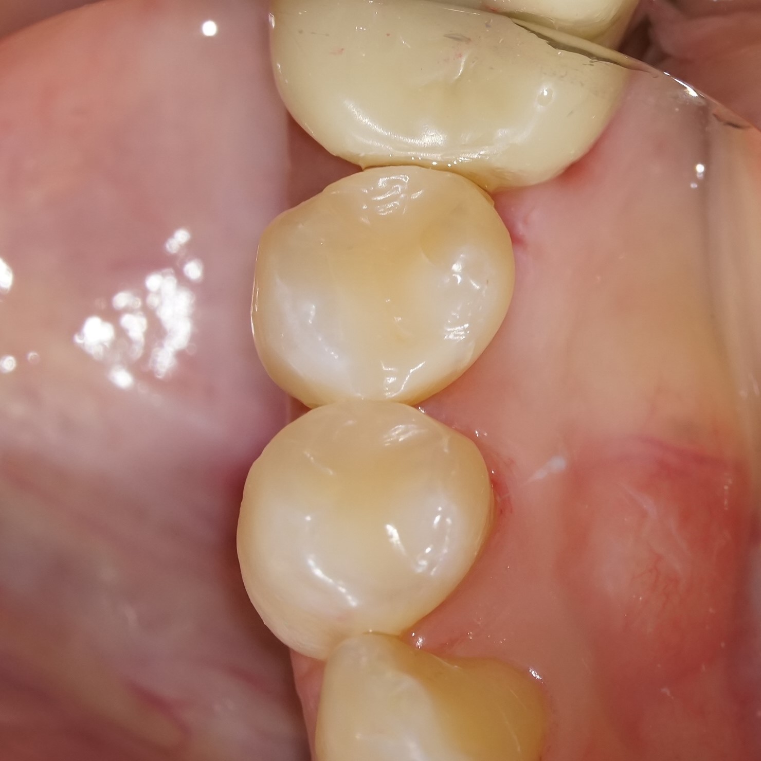 虫歯治療5治療方法05