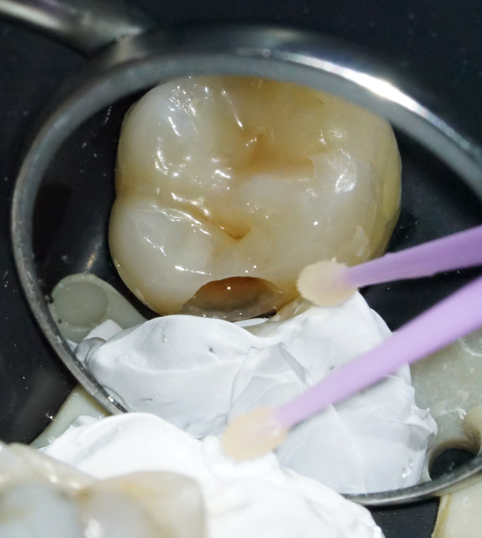 虫歯治療4治療方法03