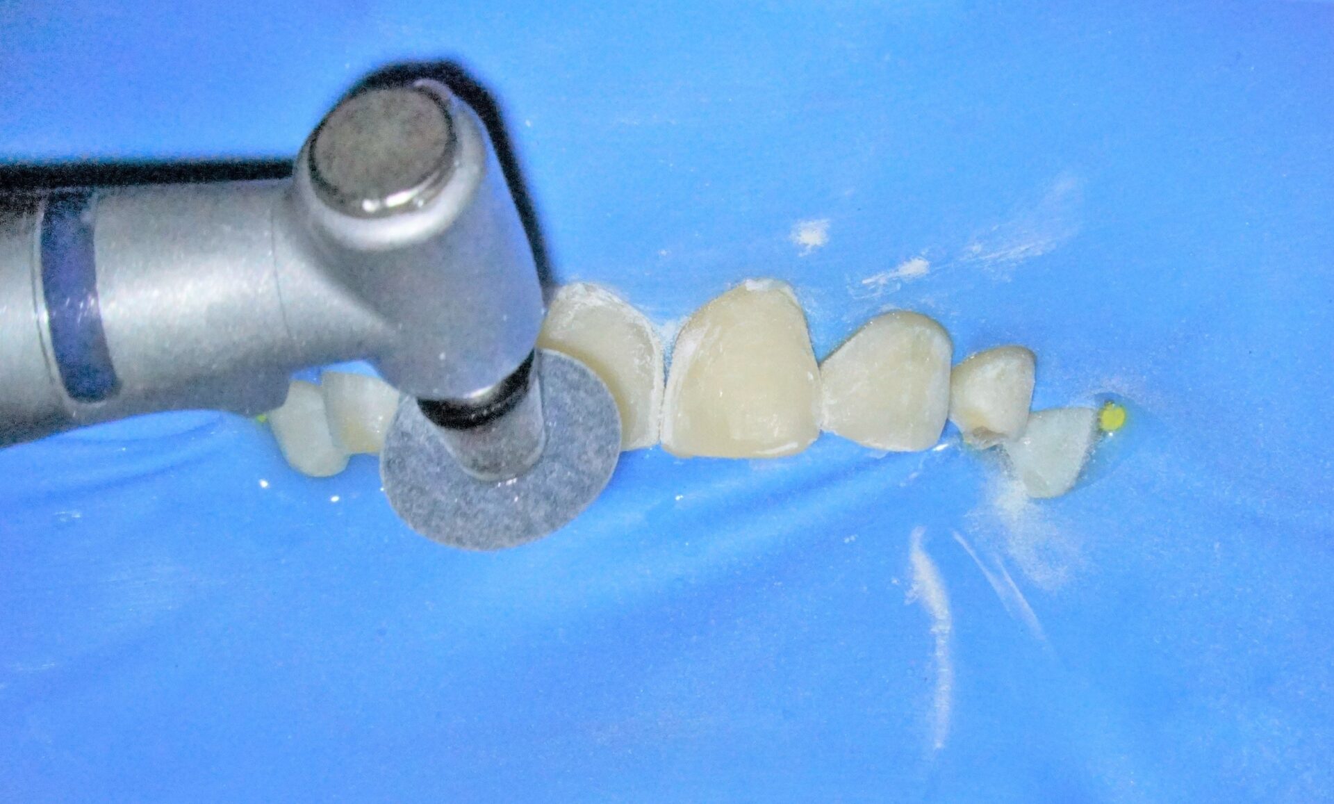 すきっ歯治療治療方法11