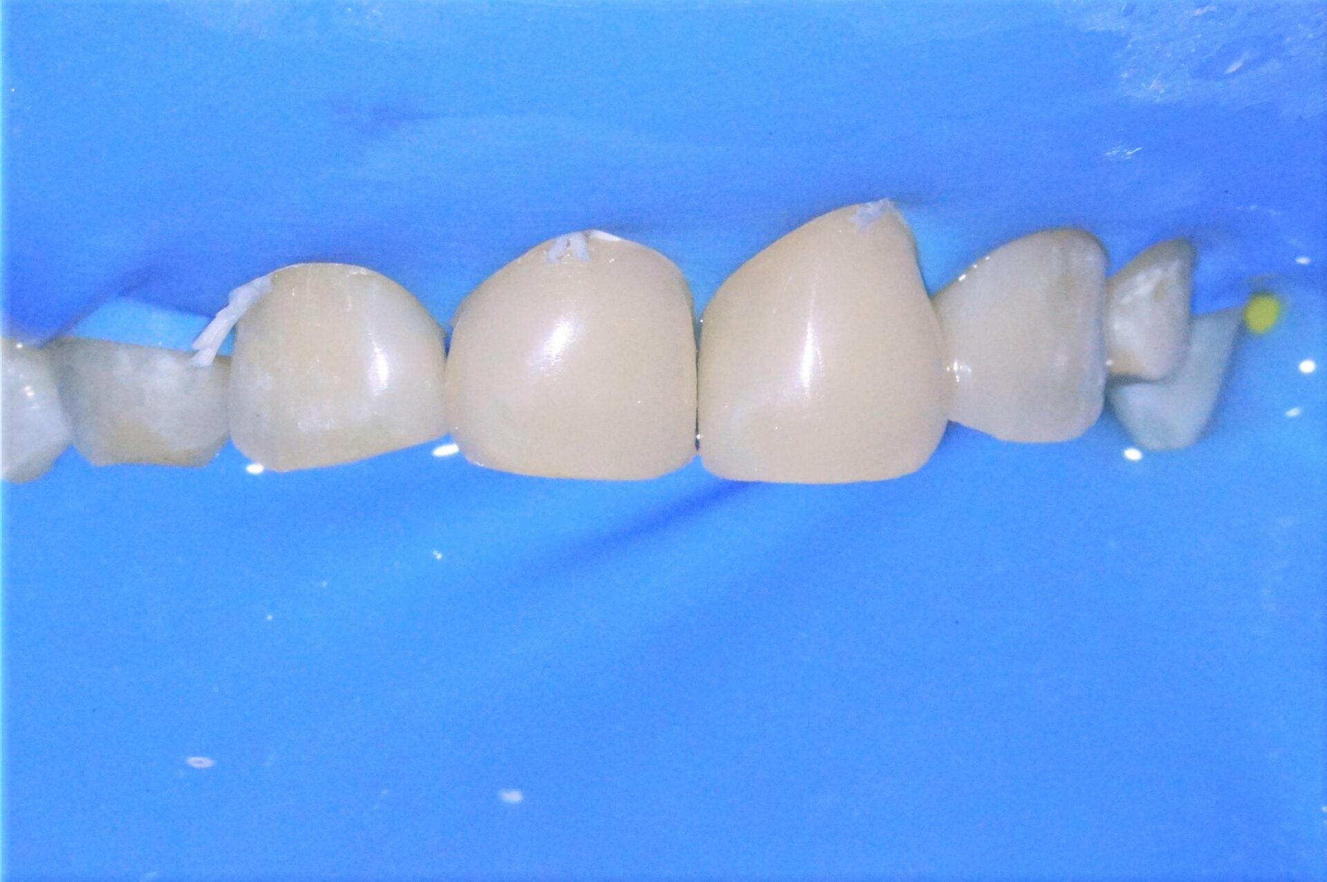 すきっ歯治療治療方法12