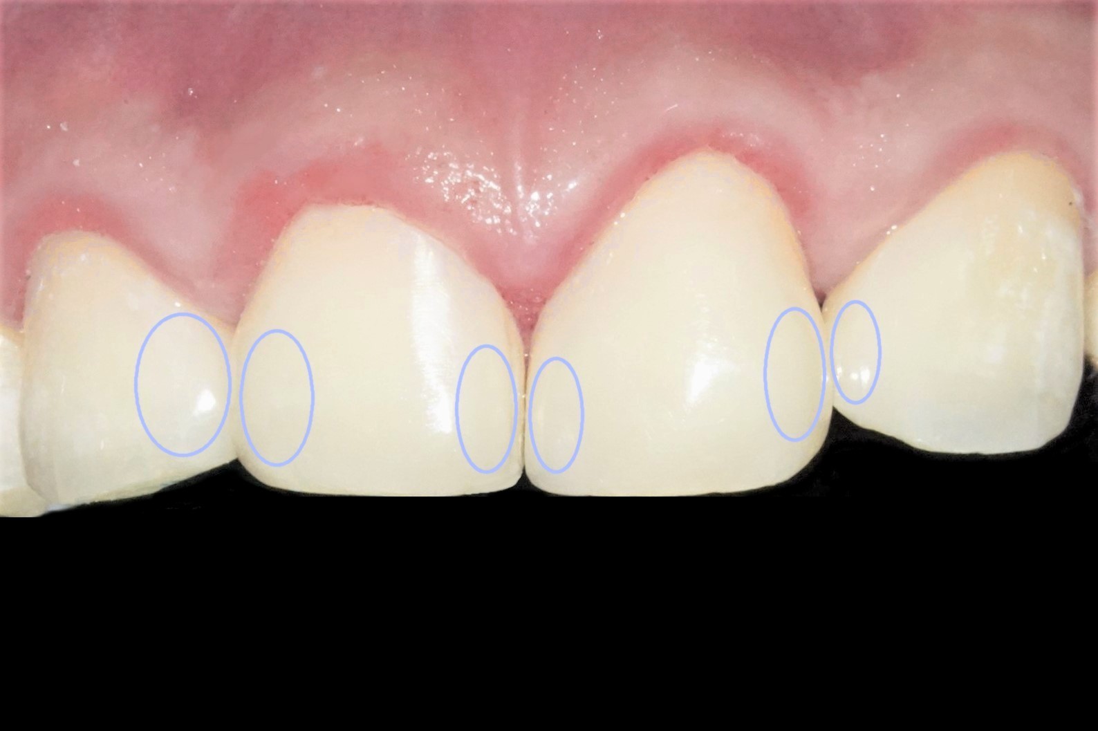 すきっ歯治療治療方法14