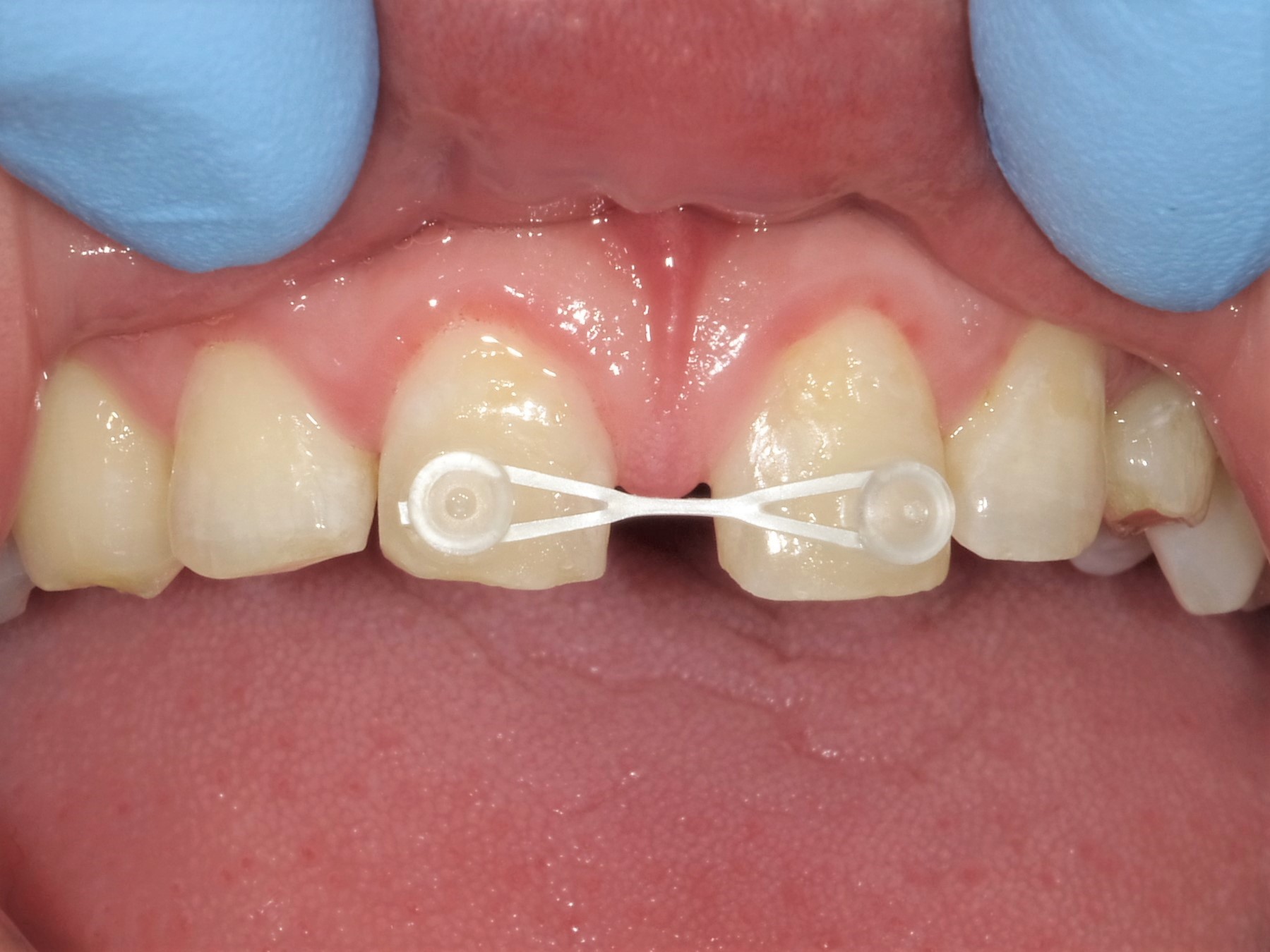 すきっ歯治療治療方法02