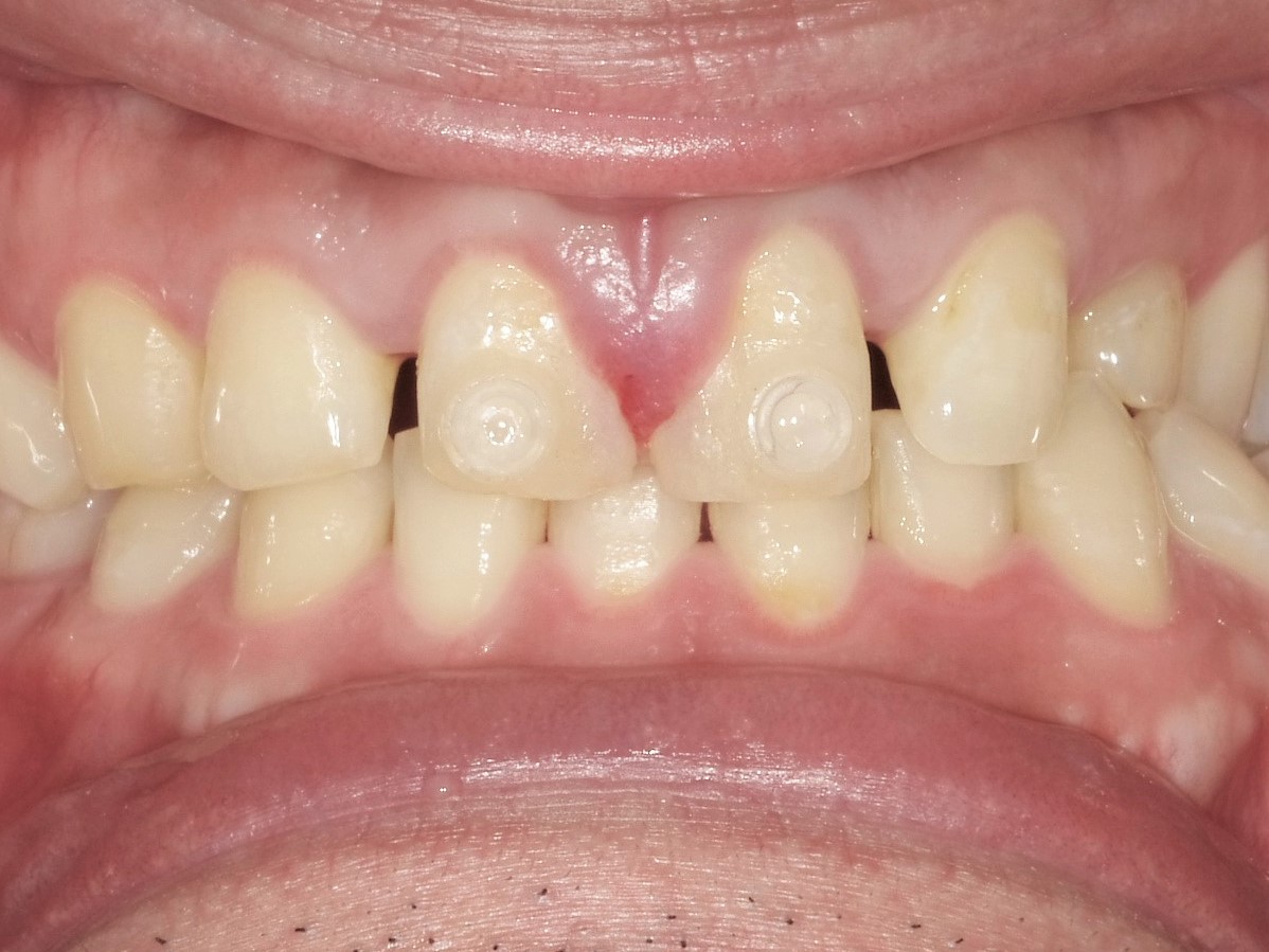 すきっ歯治療治療方法03