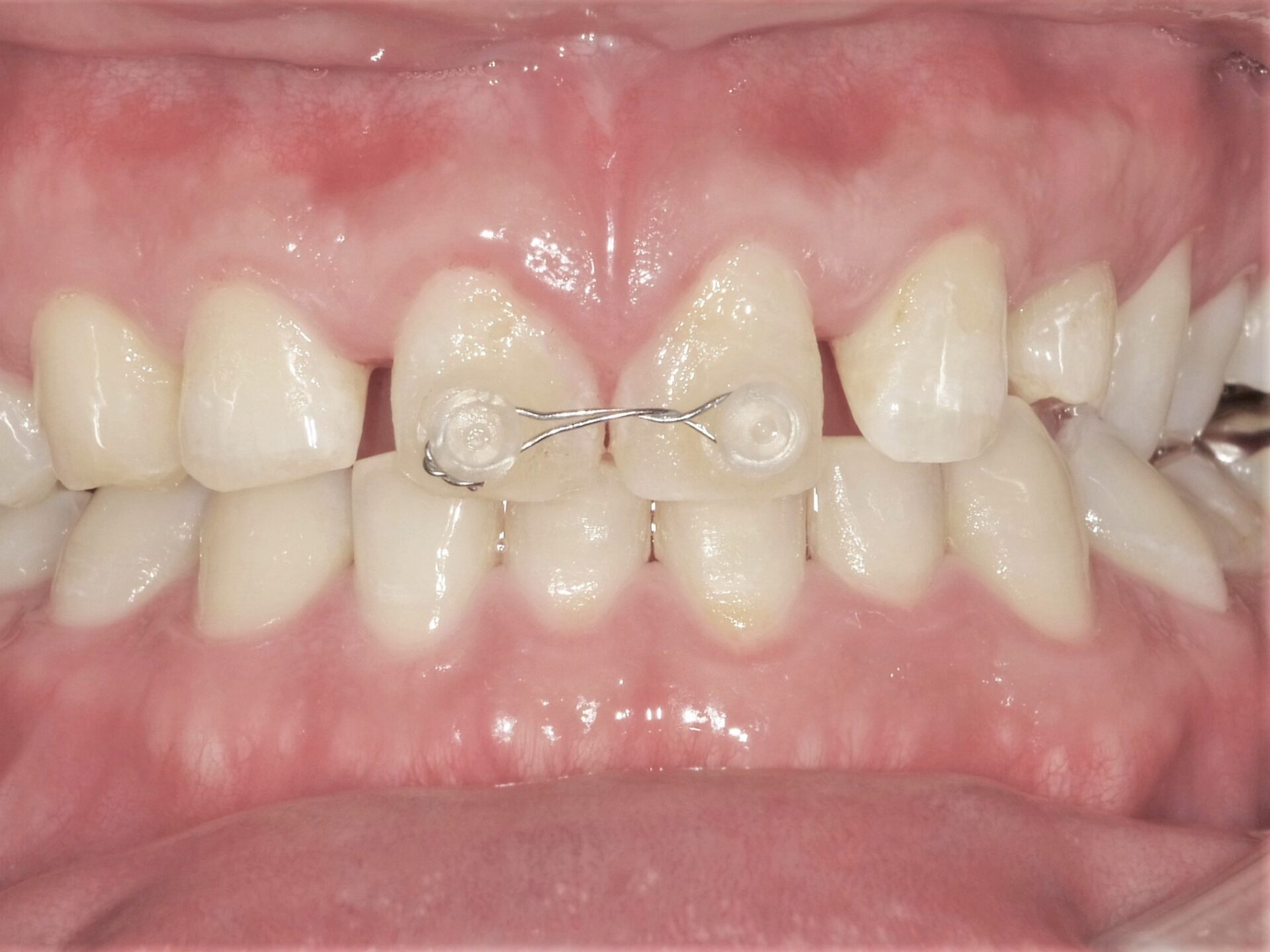 すきっ歯治療治療方法04