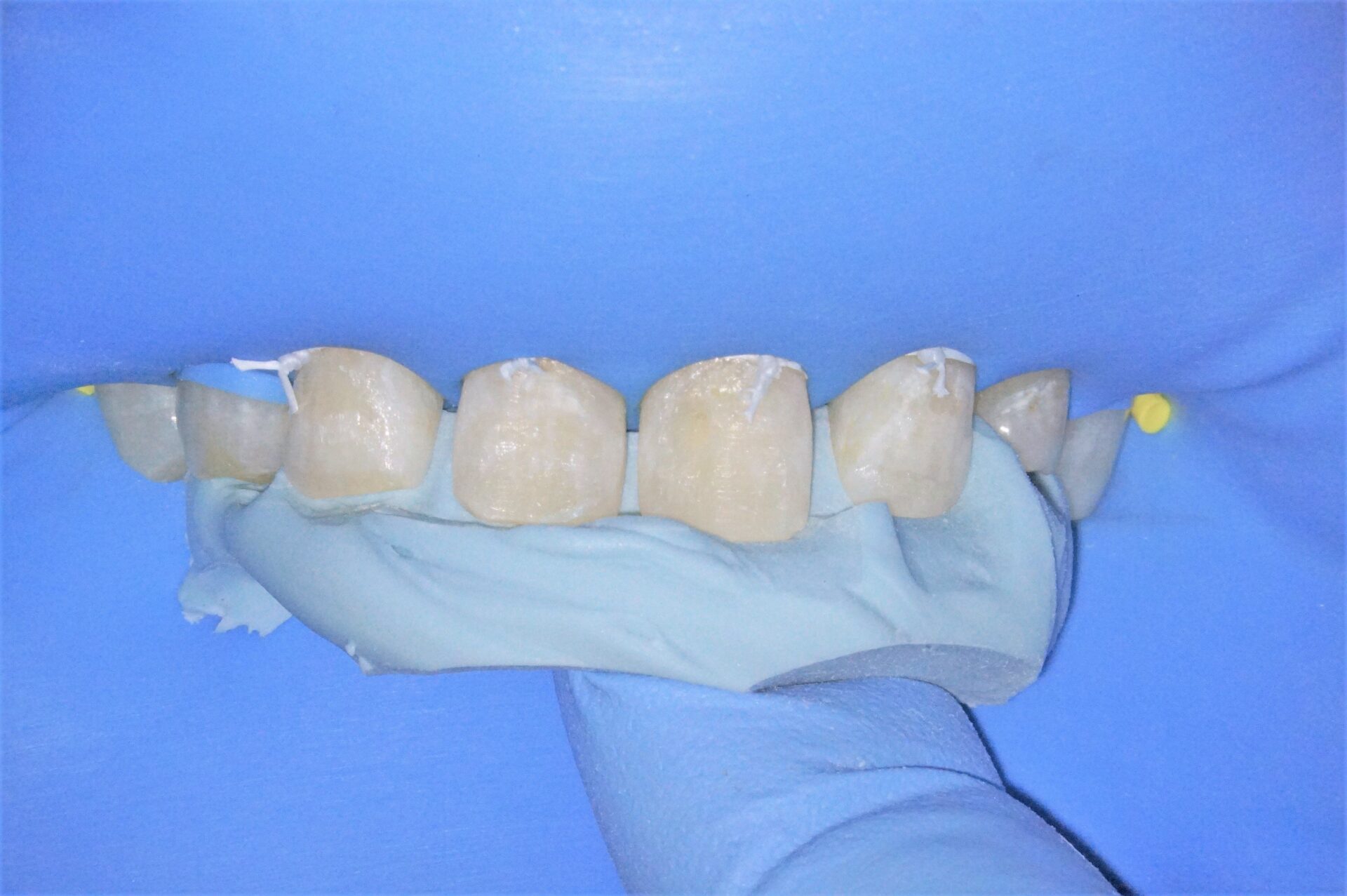 すきっ歯治療治療方法06