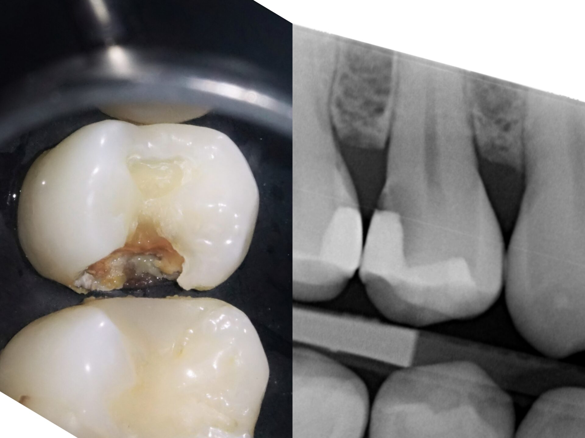 【症例】MTAセメントを使用した歯髄保護BEFORE
