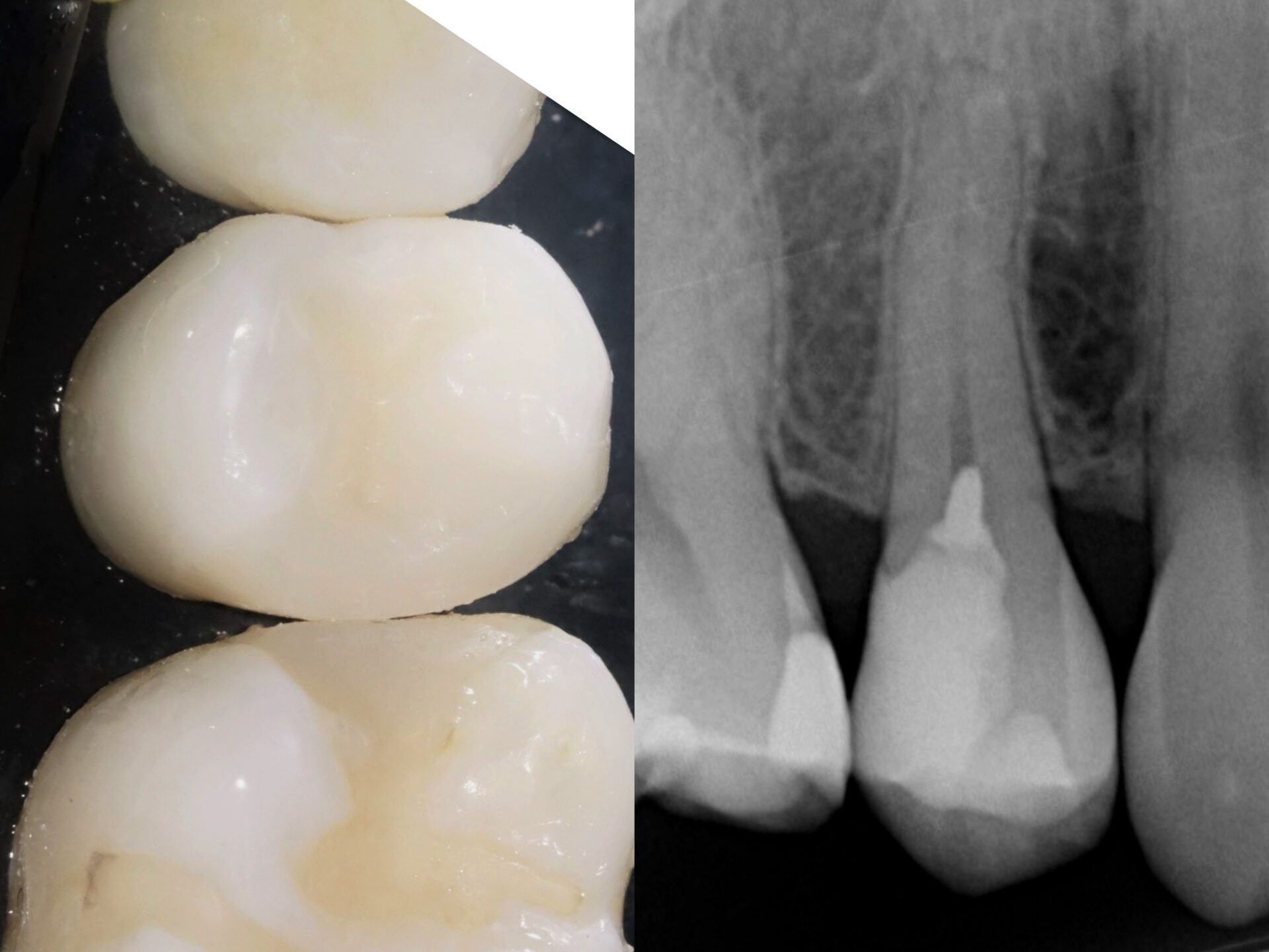 【症例】MTAセメントを使用した歯髄保護BEFORE