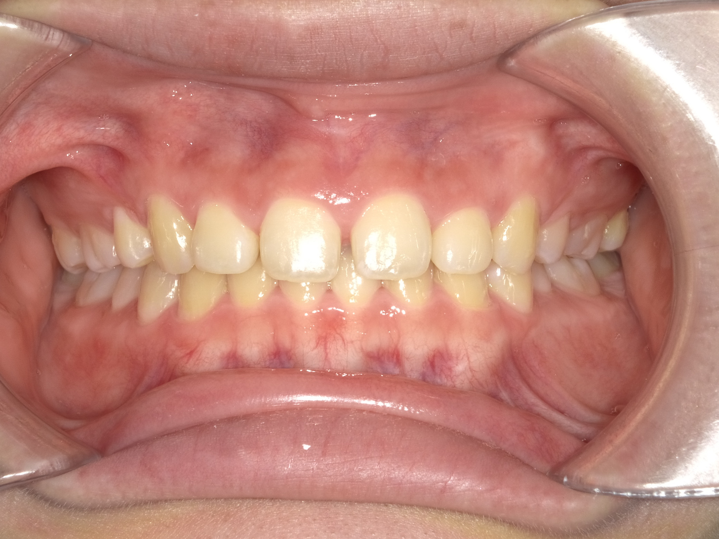 【症例】ホワイトニング＋すきっ歯治療　3治療方法01