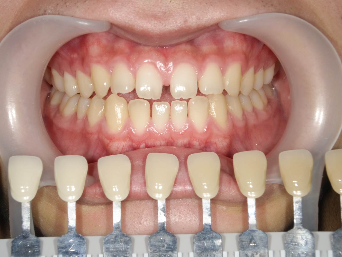 ホワイトニング＋すきっ歯治療　1治療方法02