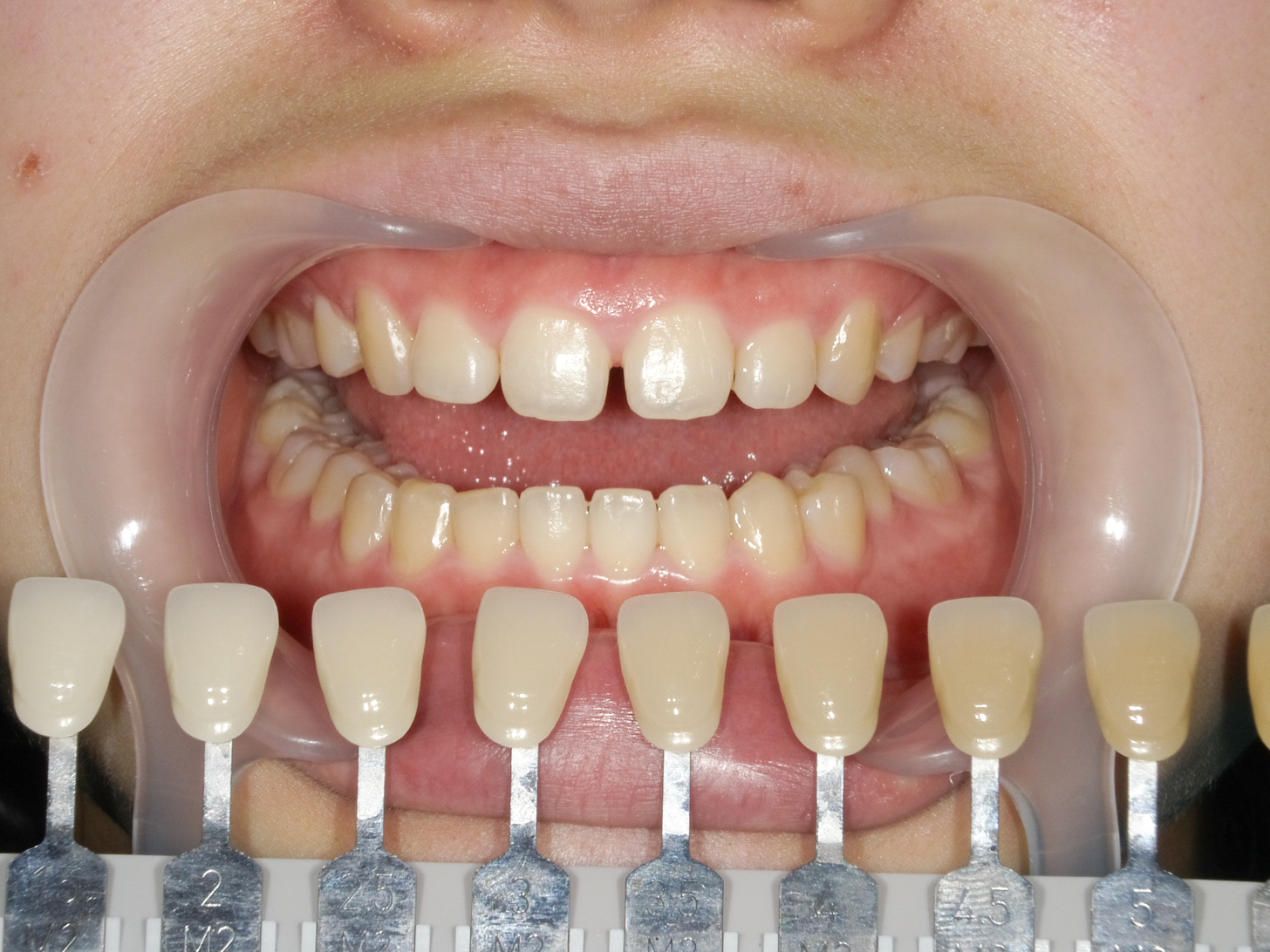 【症例】ホワイトニング＋すきっ歯治療　3治療方法02