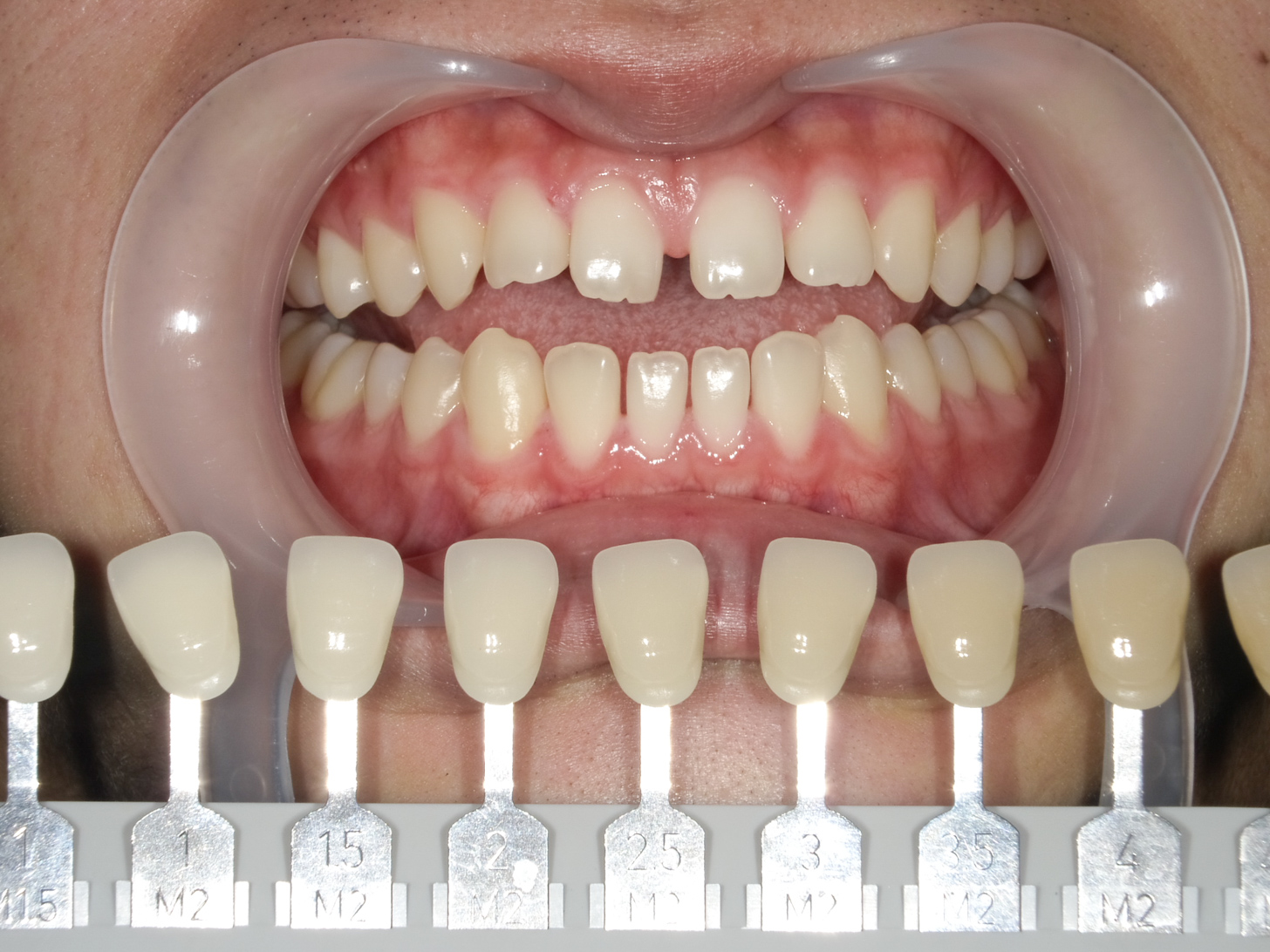 ホワイトニング＋すきっ歯治療　1治療方法03