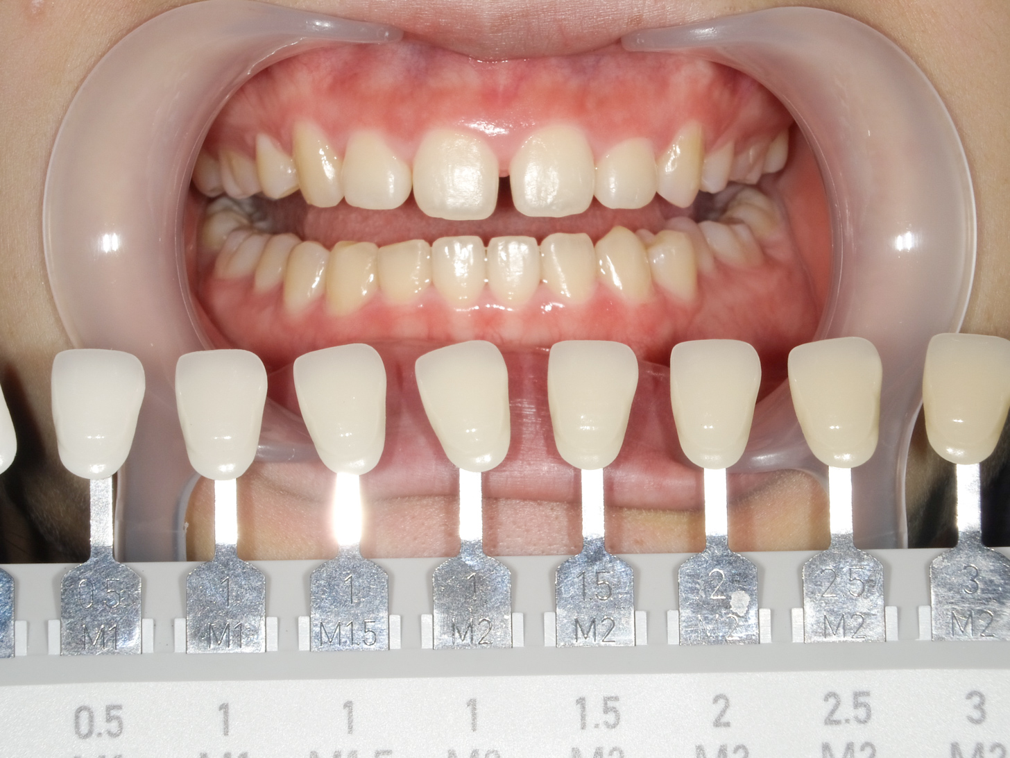 【症例】ホワイトニング＋すきっ歯治療　3治療方法03