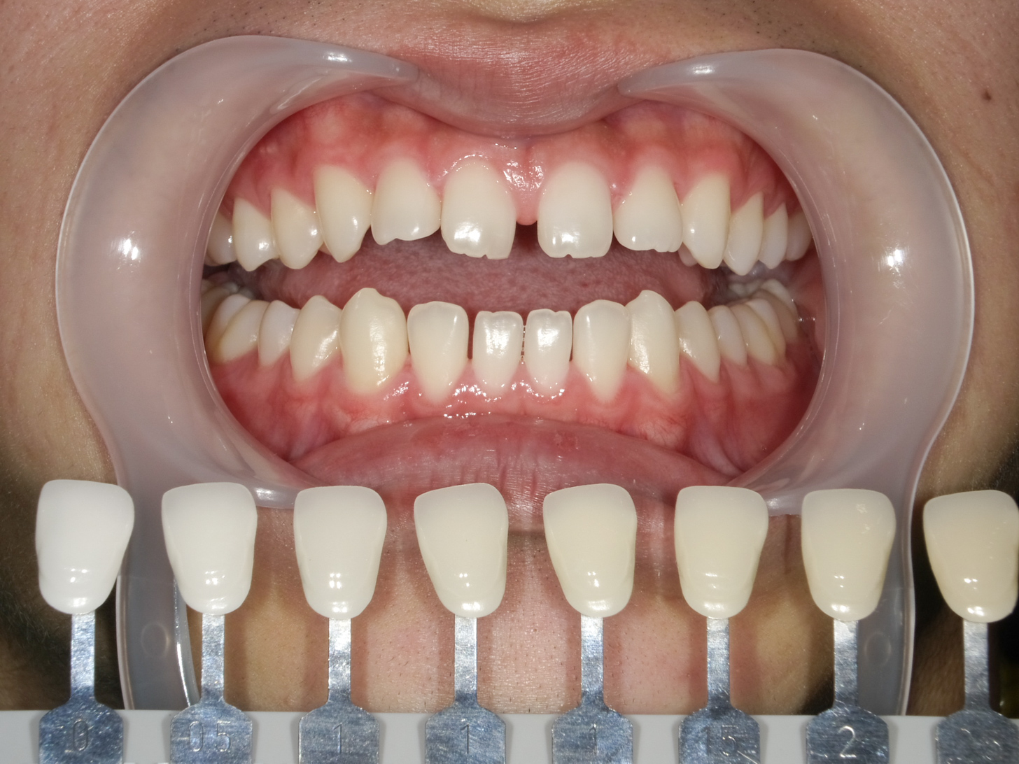ホワイトニング＋すきっ歯治療　1治療方法04