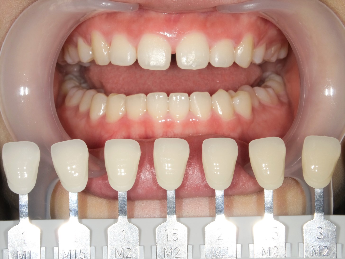 【症例】ホワイトニング＋すきっ歯治療　3治療方法04