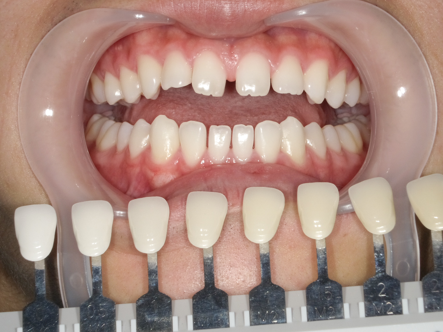 ホワイトニング＋すきっ歯治療　1治療方法05