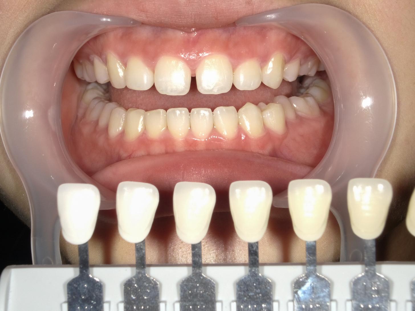 【症例】ホワイトニング＋すきっ歯治療　3治療方法05