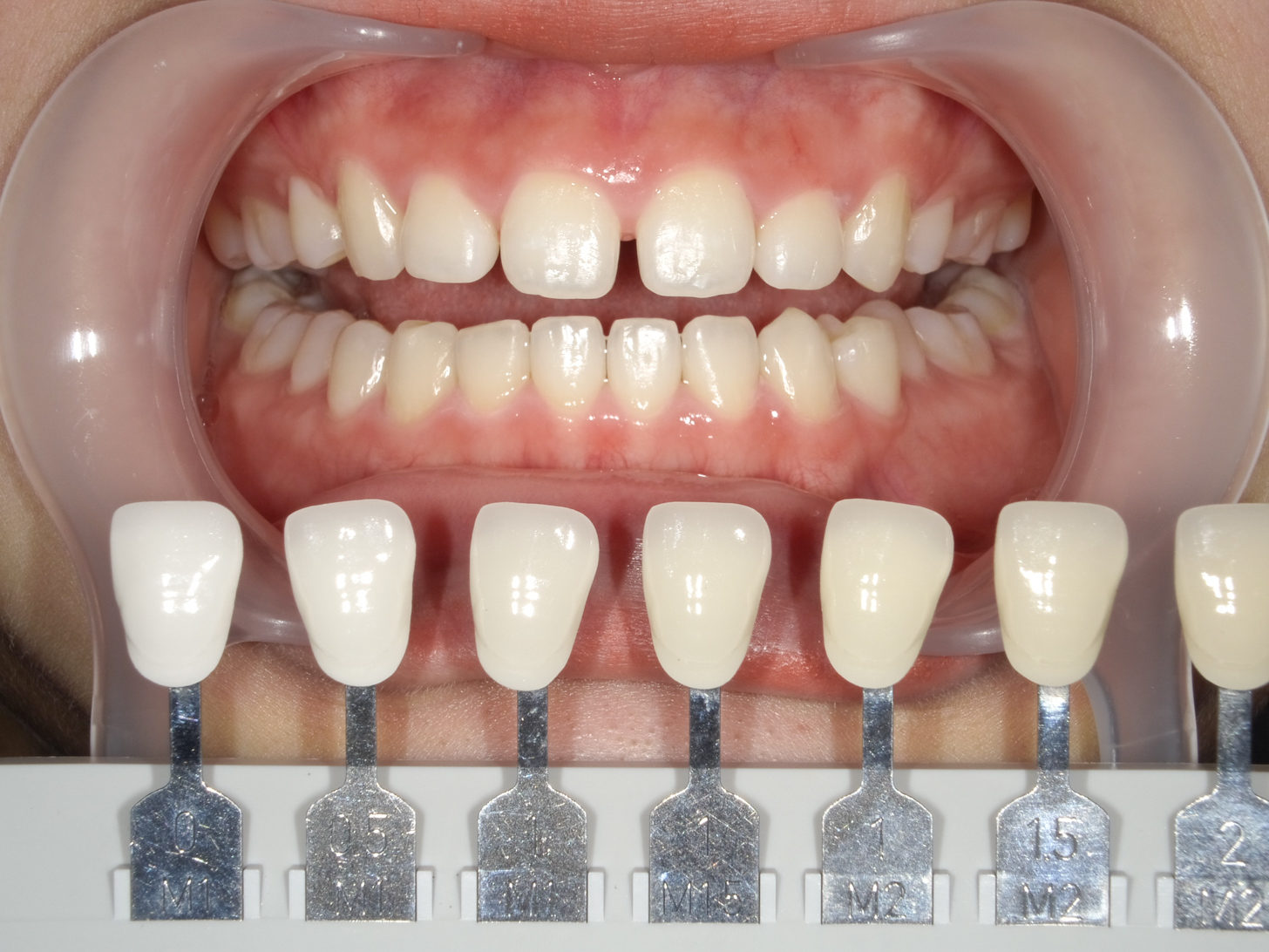 【症例】ホワイトニング＋すきっ歯治療　3治療方法06