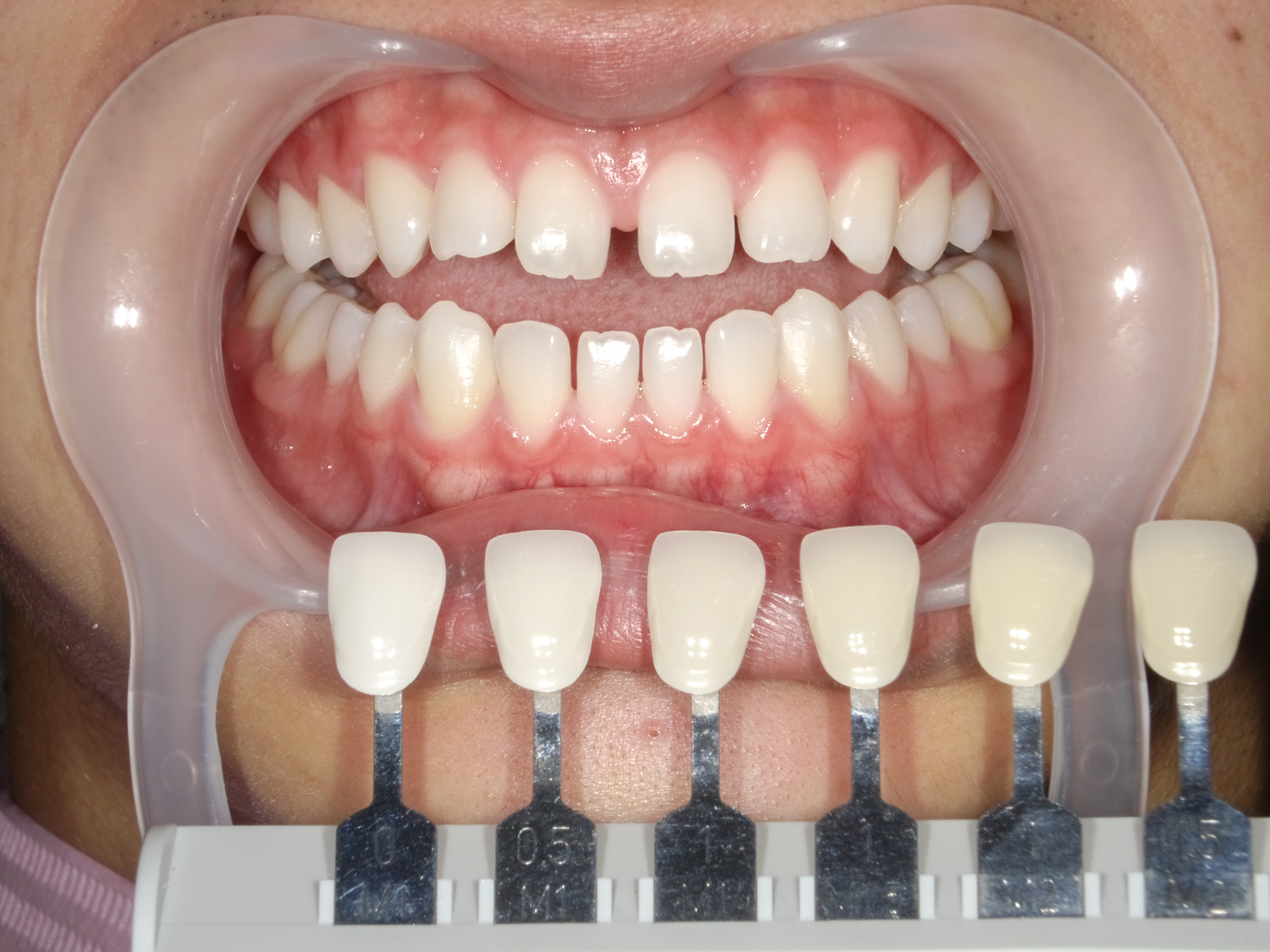 ホワイトニング＋すきっ歯治療　1治療方法06