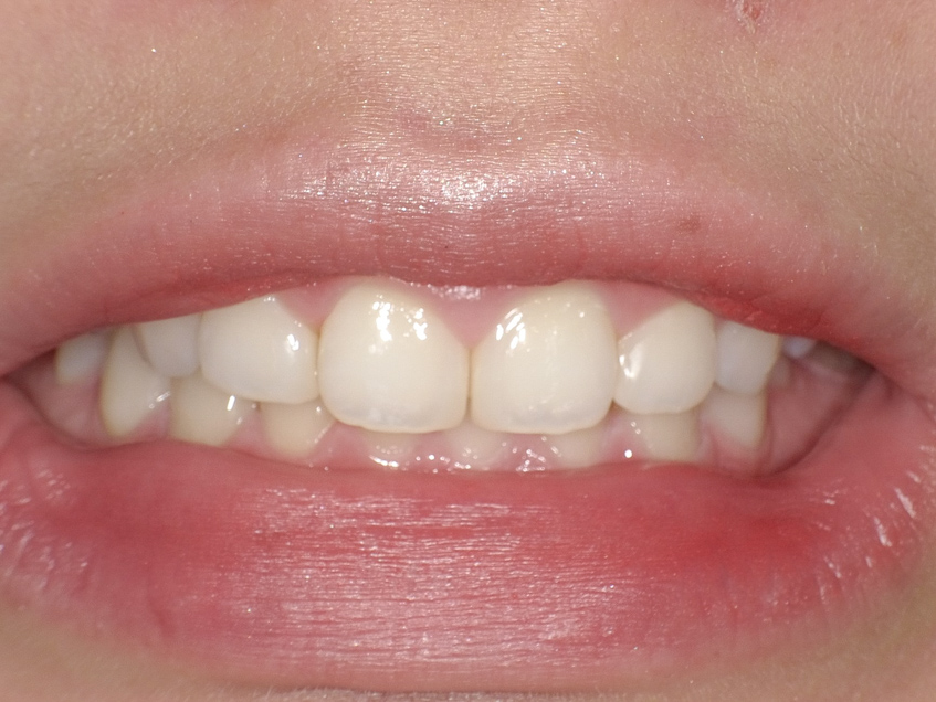 【症例】ホワイトニング＋すきっ歯治療　2