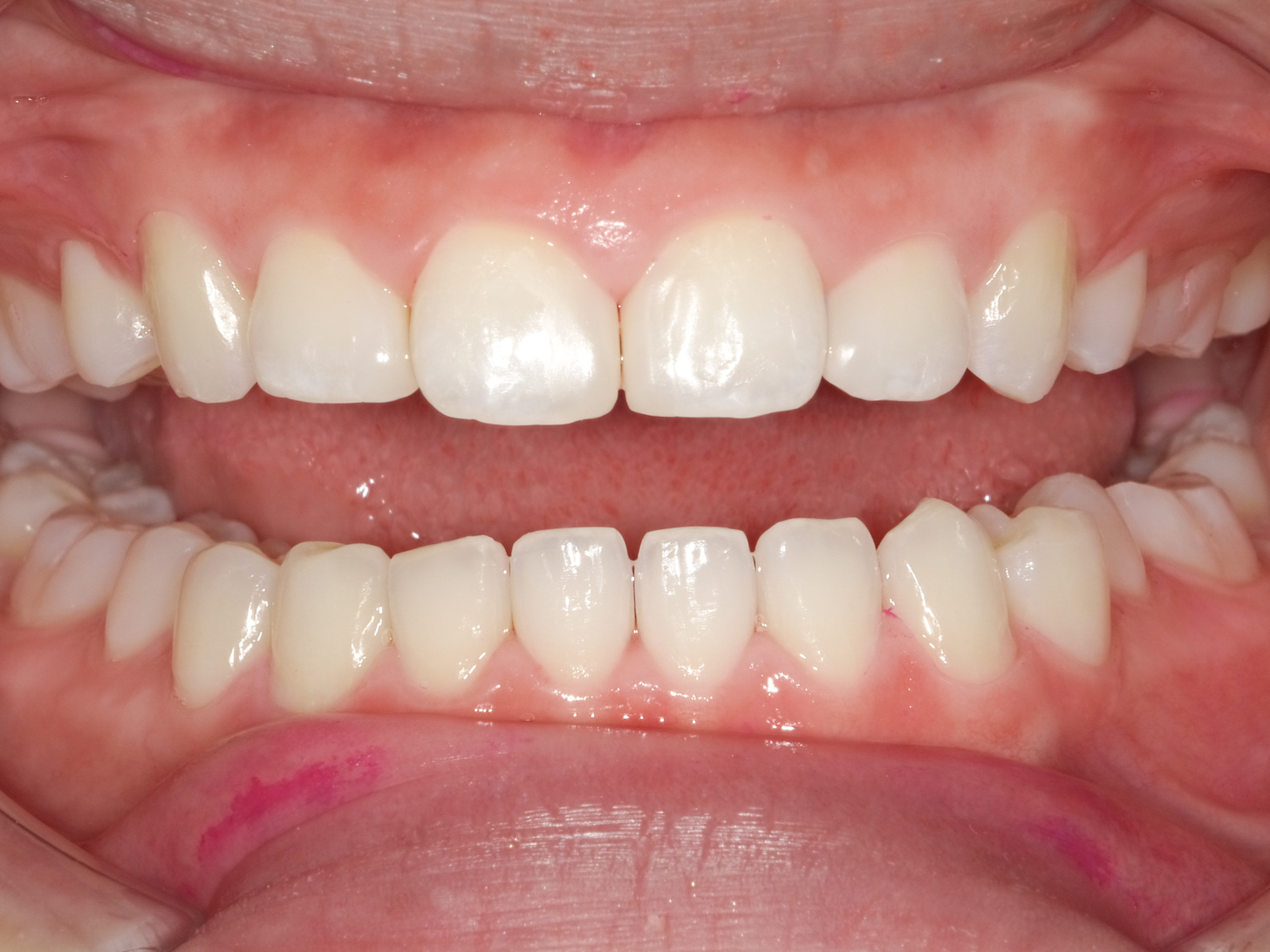【症例】ホワイトニング＋すきっ歯治療　3治療方法07
