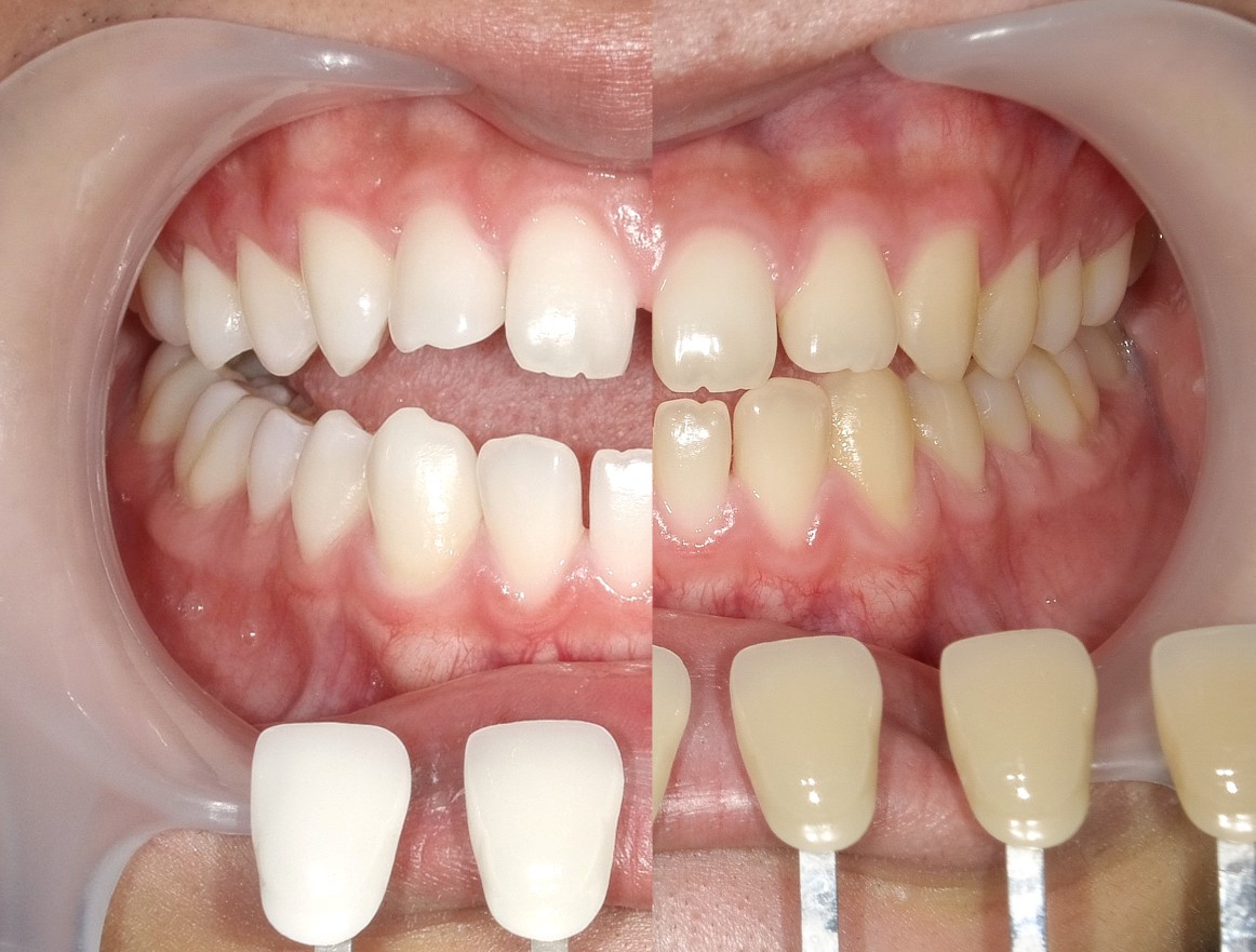 ホワイトニング＋すきっ歯治療　1治療方法07