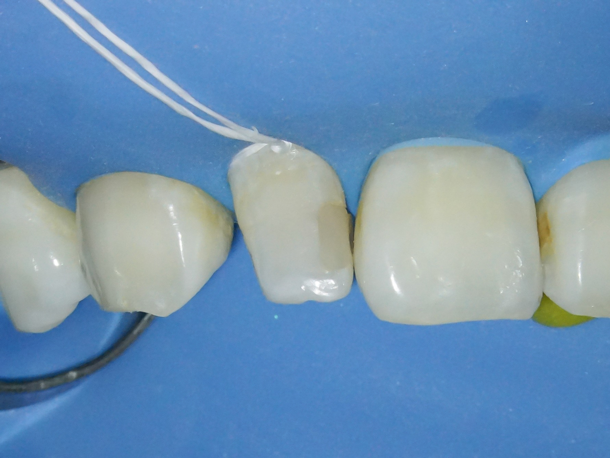 【症例】部分矯正＋ホワイトニング＋すきっ歯治療　治療方法06