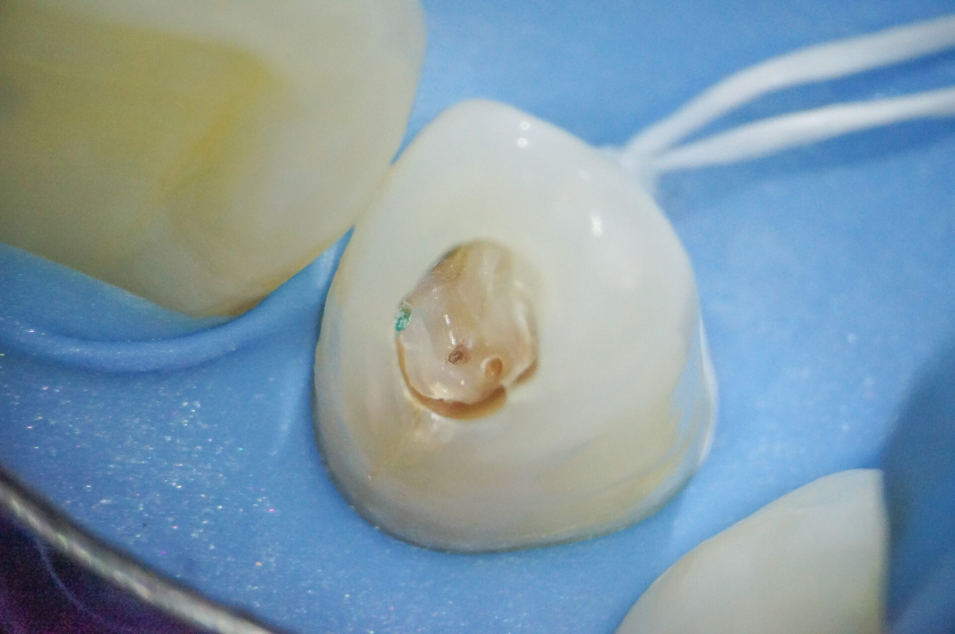 【症例】部分矯正＋ホワイトニング＋すきっ歯治療　治療方法09