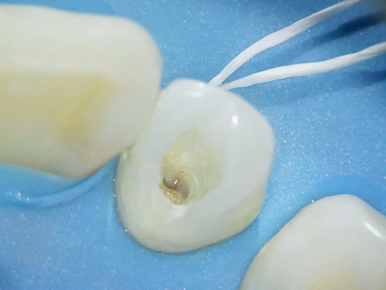 【症例】部分矯正＋ホワイトニング＋すきっ歯治療　治療方法11