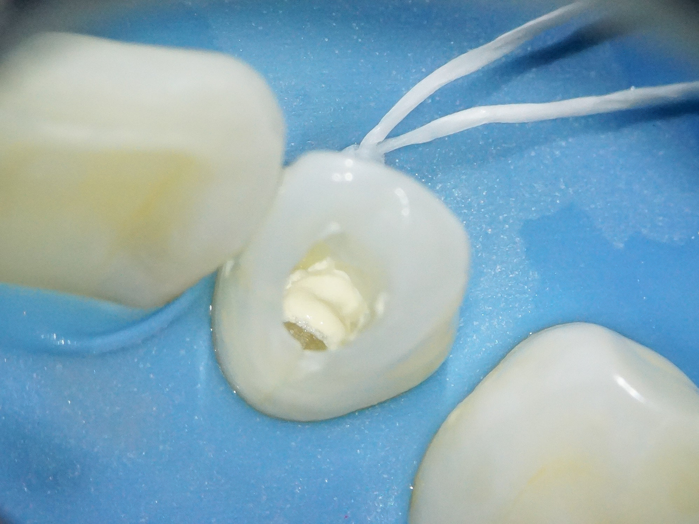 【症例】部分矯正＋ホワイトニング＋すきっ歯治療　治療方法12