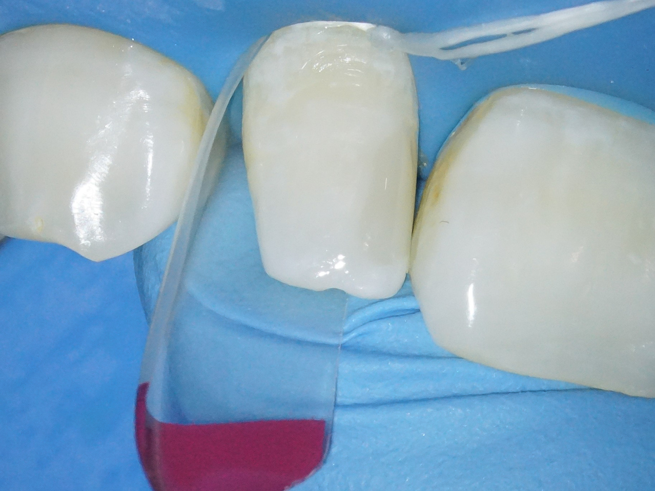 【症例】部分矯正＋ホワイトニング＋すきっ歯治療　治療方法14