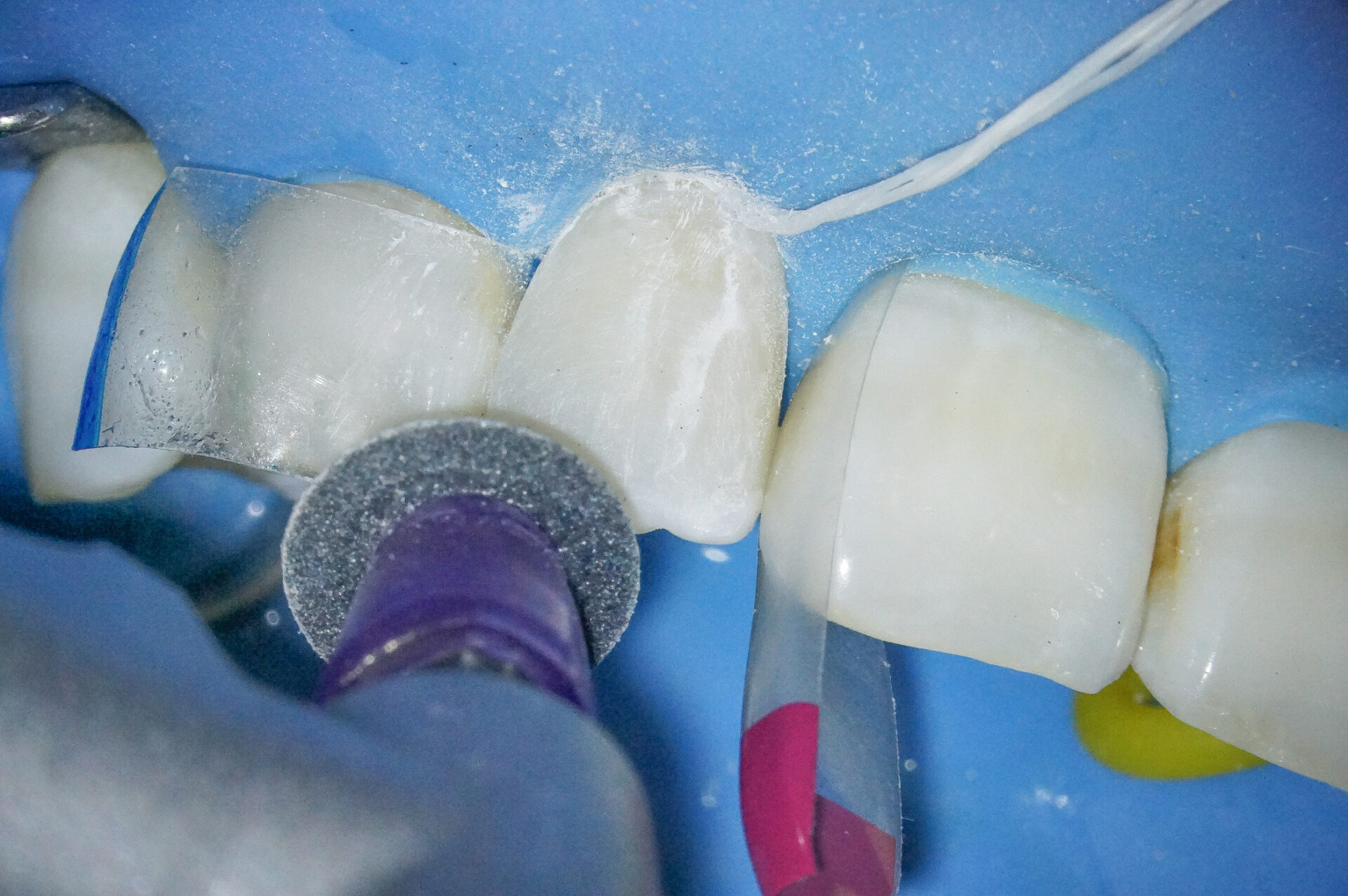 【症例】部分矯正＋ホワイトニング＋すきっ歯治療　治療方法16