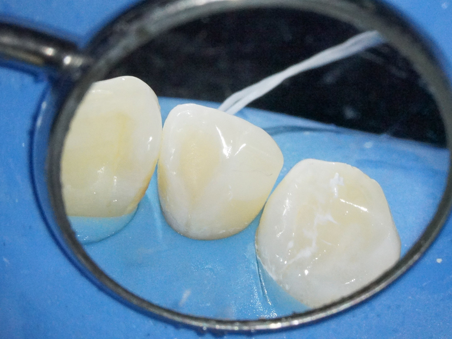 【症例】部分矯正＋ホワイトニング＋すきっ歯治療　治療方法19