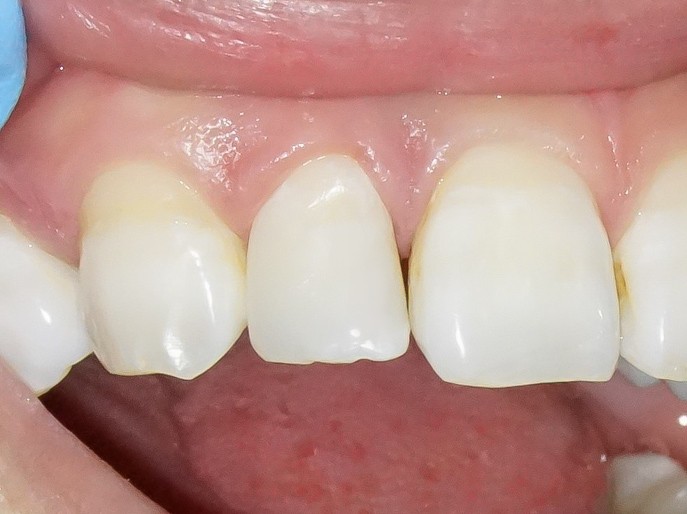 【症例】部分矯正＋ホワイトニング＋すきっ歯治療　