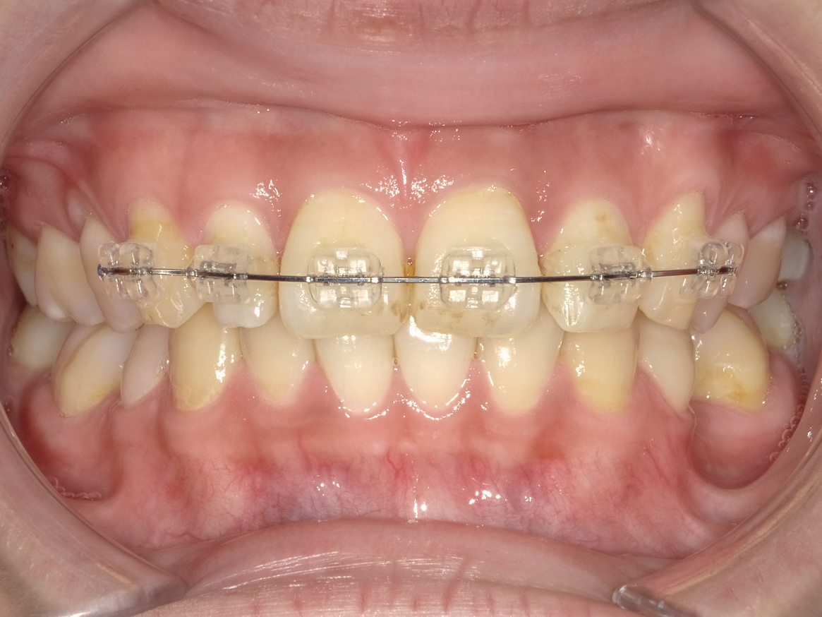 部分矯正＋ホワイトニング＋すきっ歯治療　治療方法02