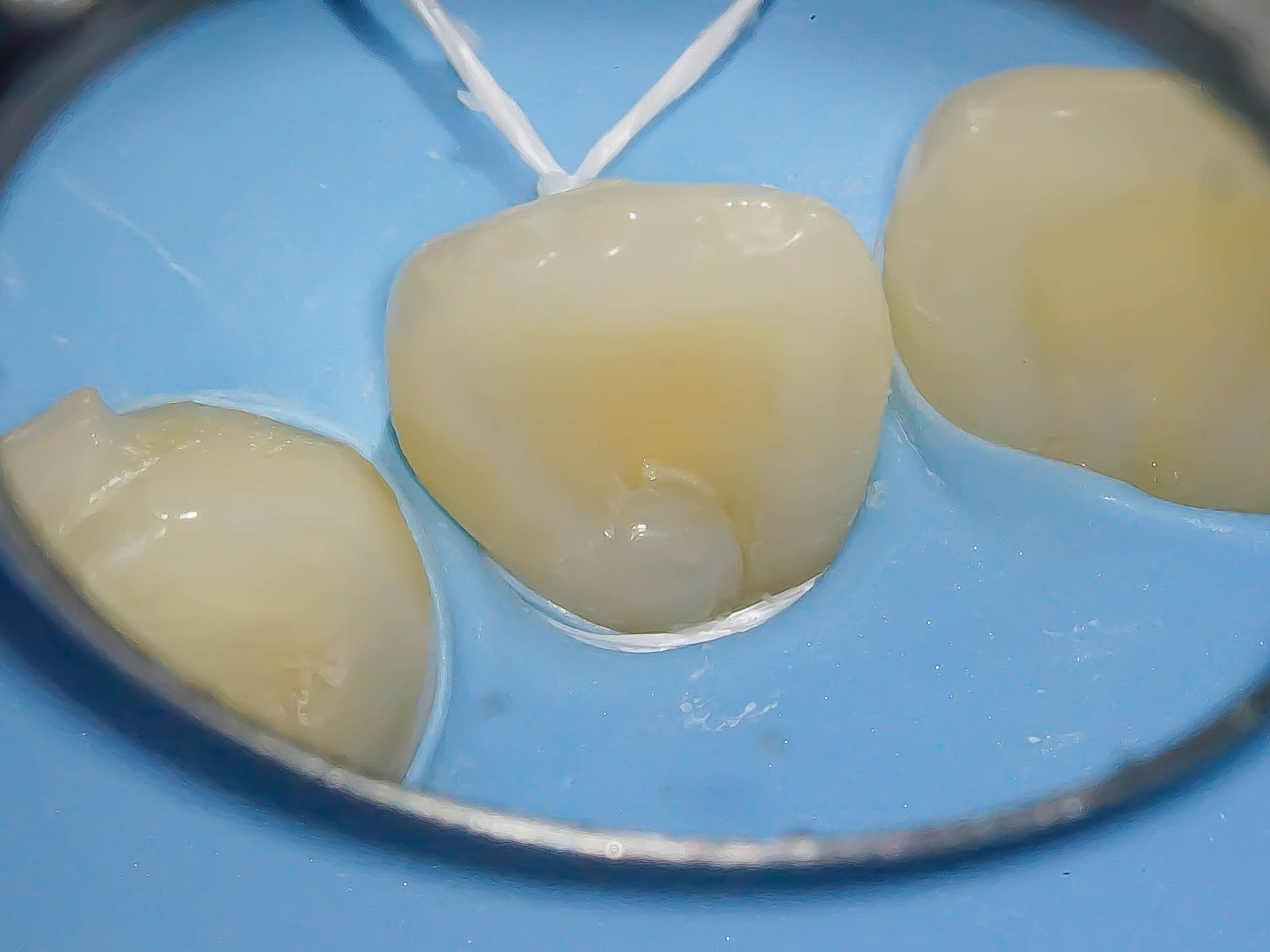 【症例】舌盲孔（歯内歯）をダイレクトボンディングにて修復治療方法01