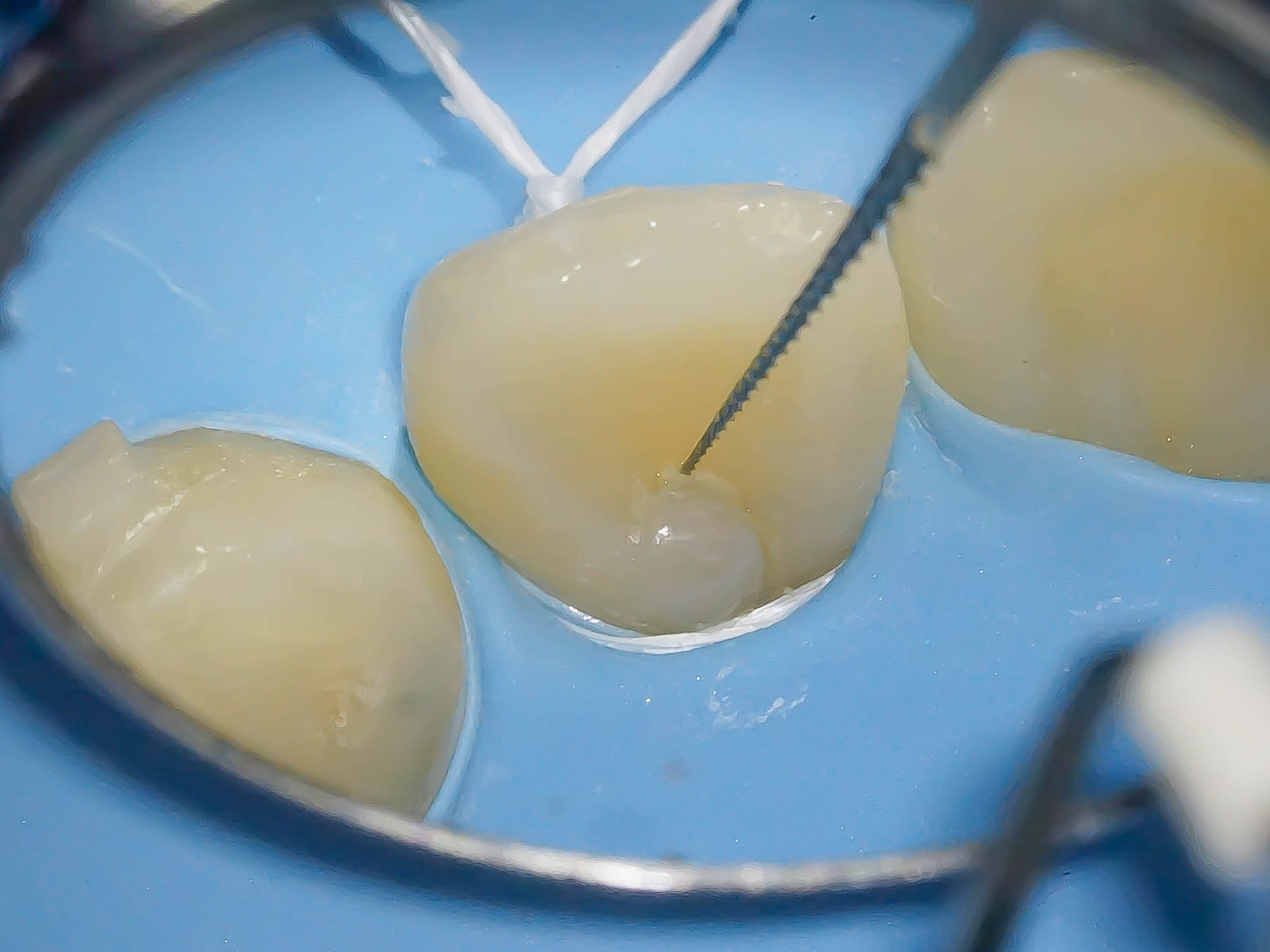 【症例】舌盲孔（歯内歯）をダイレクトボンディングにて修復治療方法02