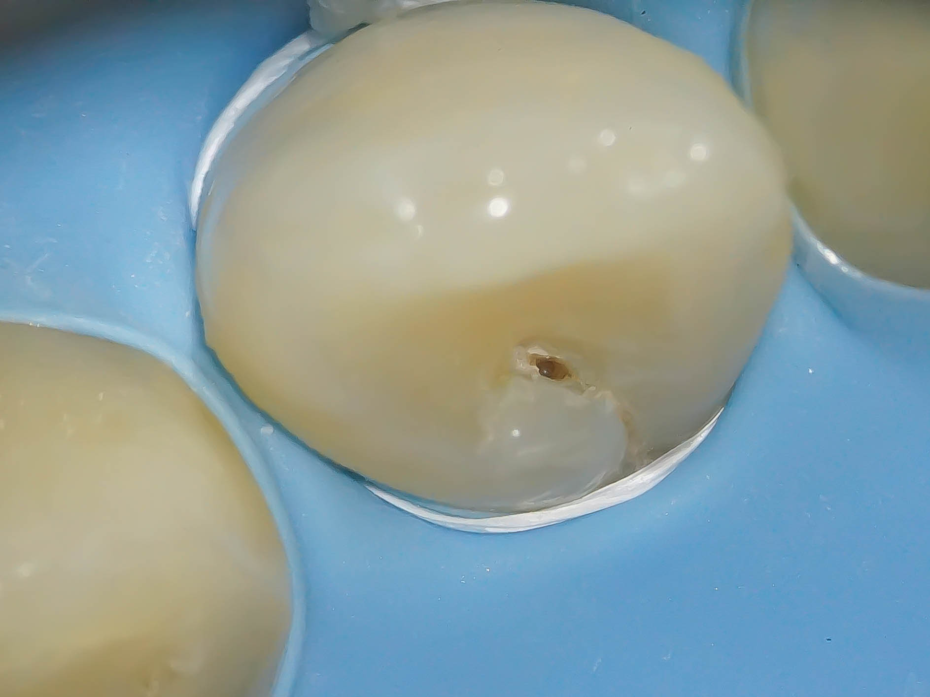【症例】舌盲孔（歯内歯）をダイレクトボンディングにて修復治療方法07