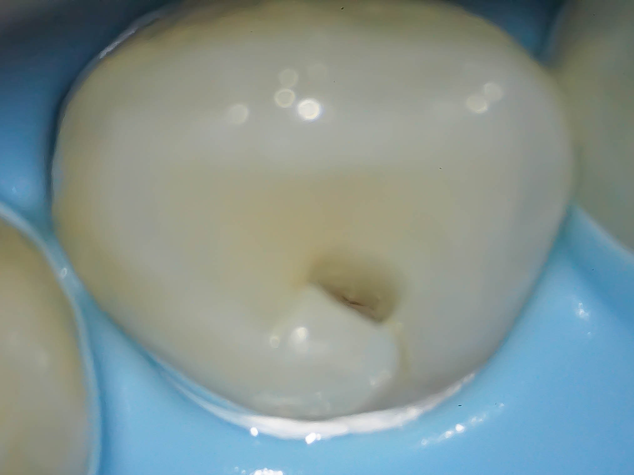 【症例】舌盲孔（歯内歯）をダイレクトボンディングにて修復治療方法08