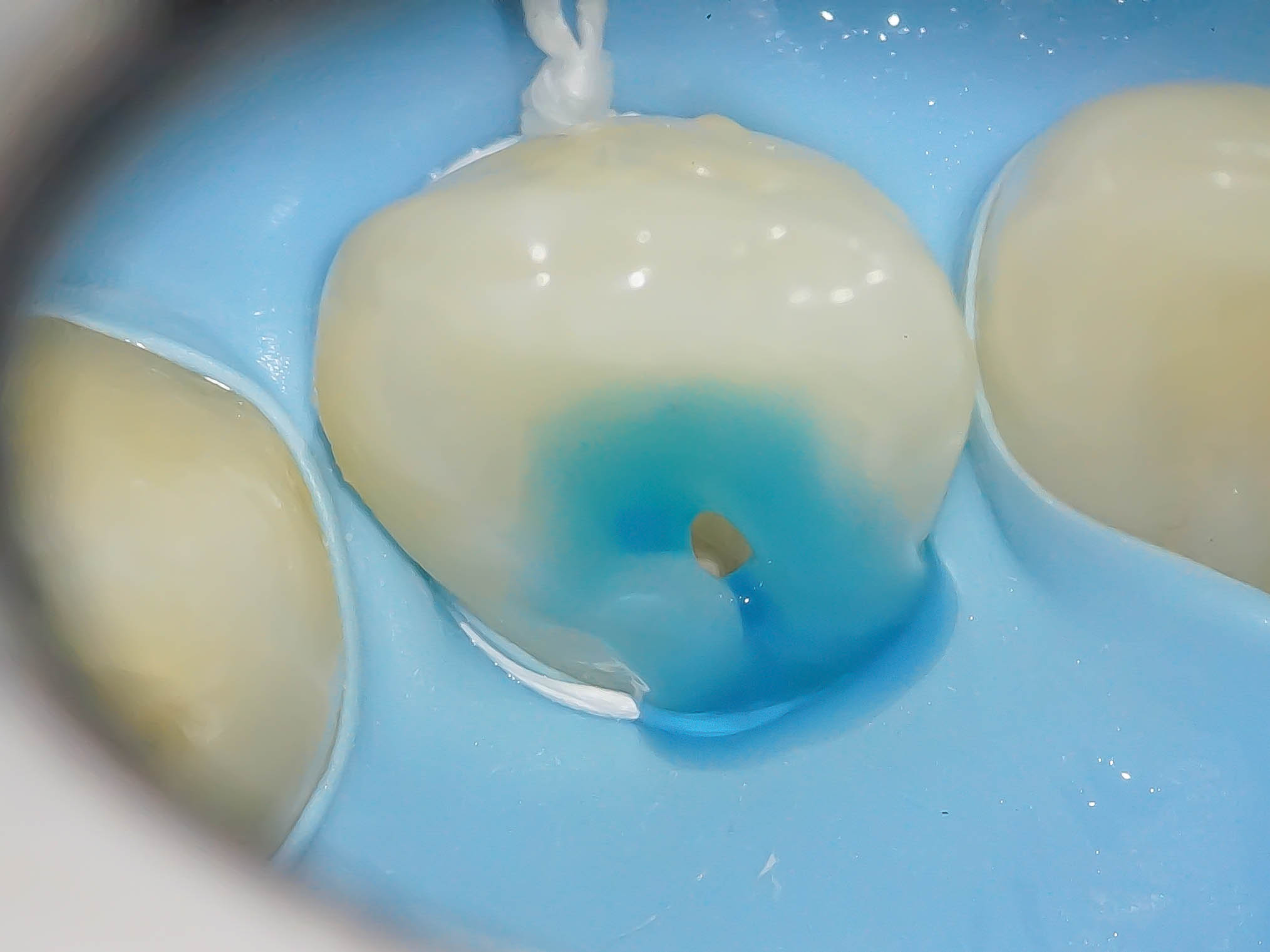 【症例】舌盲孔（歯内歯）をダイレクトボンディングにて修復治療方法12