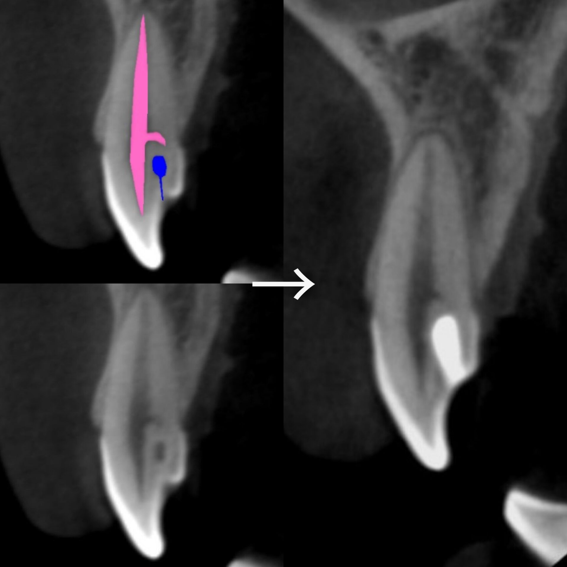 【症例】舌盲孔（歯内歯）をダイレクトボンディングにて修復治療方法16