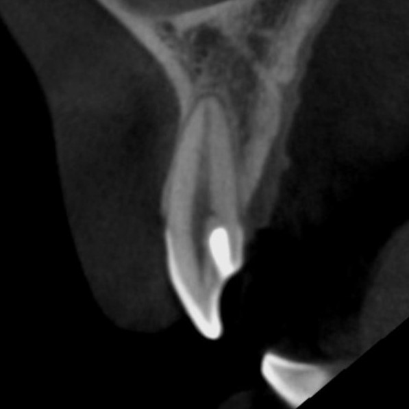 【症例】舌盲孔（歯内歯）をダイレクトボンディングにて修復BEFORE