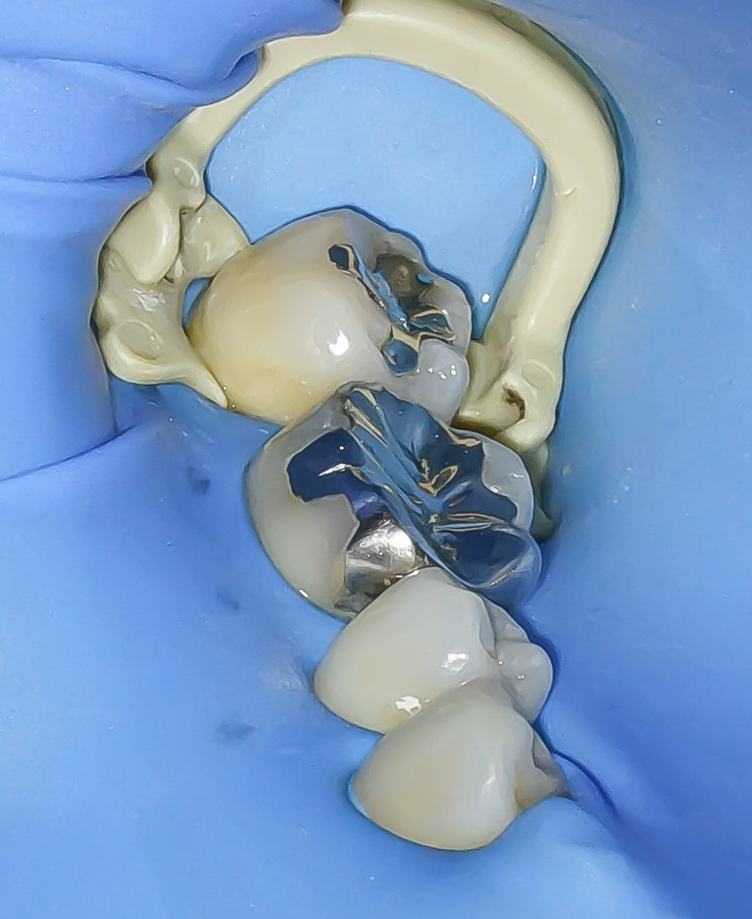 銀歯を外しハイトランスジルコニアにて修復した症例治療方法03
